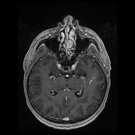 Cerebellar metastasis of pulmonary adenocarcinoma, cavernous venous malformation, and developmental venous anomaly (Radiopaedia 85827-101661 Axial T1 C+ 46).jpg