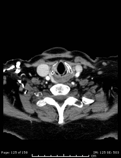 Cerebellar strokes due to intracranial giant cell arteritis (Radiopaedia 68799-78510 CT angiogram 125).jpg