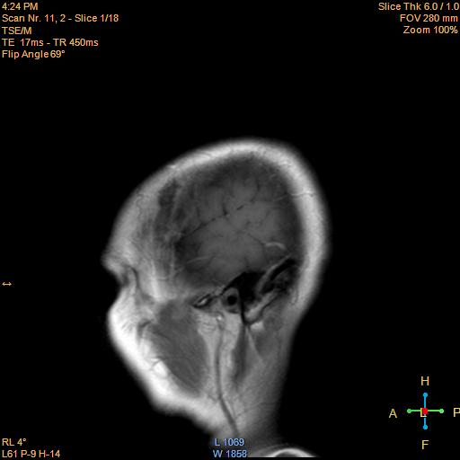 File:Cerebellopontine angle meningioma (Radiopaedia 22488-22525 Sagittal T1 C+ 1).jpg