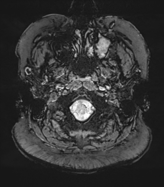 Cerebellopontine angle meningioma (Radiopaedia 48434-53348 Axial SWI 5).png