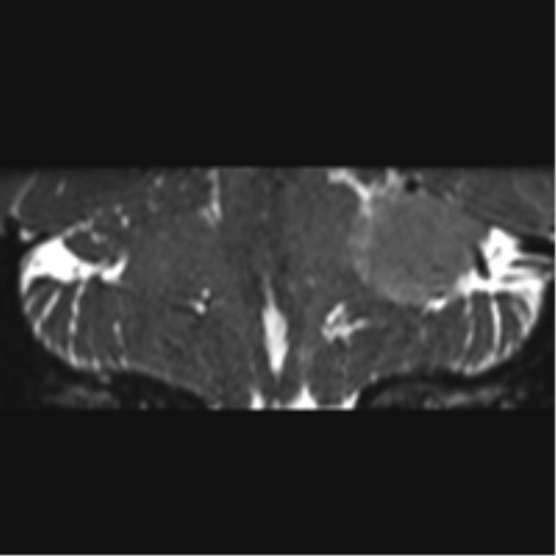 Cerebellopontine angle meningioma (Radiopaedia 48434-53348 Coronal T2 33).png