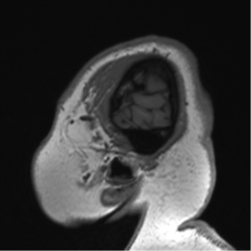 Cerebellopontine angle meningioma (Radiopaedia 48434-53348 Sagittal T1 11).png