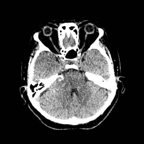 Cerebellopontine angle meningioma (Radiopaedia 53561-59592 Axial non-contrast 20).jpg