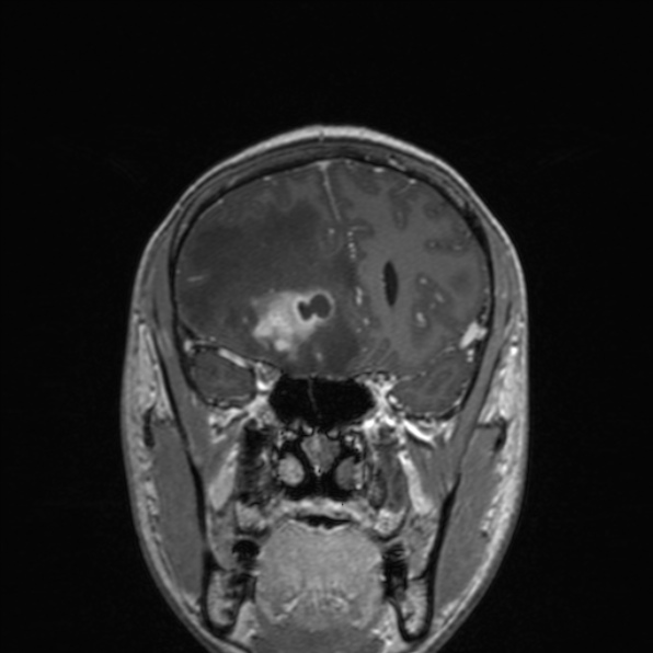 Cerebral abscess (Radiopaedia 24212-24478 Coronal T1 C+ 75).jpg