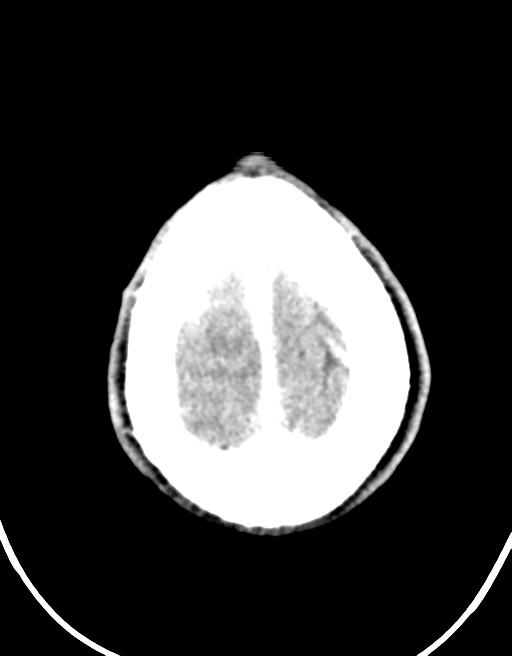 Cerebral abscess (Radiopaedia 60342-68008 Axial C+ delayed 47).png
