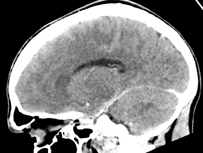 Cerebral abscess (Radiopaedia 60342-68008 Sagittal C+ delayed 21).png