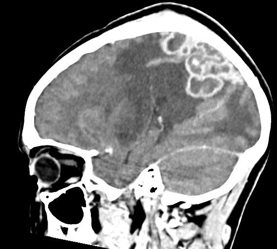 Cerebral abscesses (Radiopaedia 70458-80568 Sagittal Contrast 21).jpg