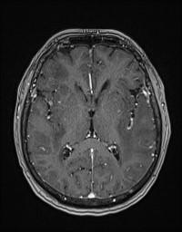 Cerebral amyloid angiopathy-related inflammation (Radiopaedia 58270-65377 Axial T1 C+ fat sat 73).jpg