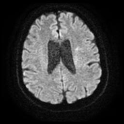 Cerebral amyloid angiopathy (Radiopaedia 28698-28978 Axial DWI 19).jpg