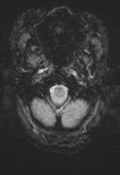 File:Cerebral amyloid angiopathy (Radiopaedia 29129-29518 Axial SWI MPR 2).jpg