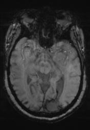 File:Cerebral amyloid angiopathy (Radiopaedia 29129-29518 Axial SWI Magnitude 15).jpg