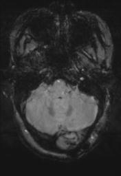 File:Cerebral amyloid angiopathy (Radiopaedia 29129-29518 Axial SWI Magnitude 6).jpg