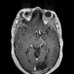 File:Cerebral amyloid angiopathy (Radiopaedia 29129-29518 Axial T1 C+ 66).jpg