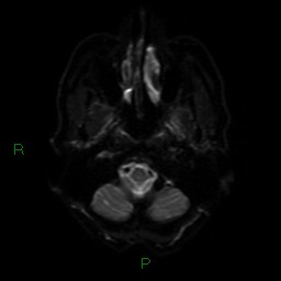 Cerebral amyloid angiopathy (Radiopaedia 77506-89664 Axial DWI 32).jpg