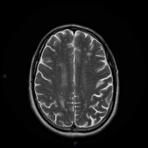 File:Cerebral amyloid angiopathy (Radiopaedia 77506-89664 Axial T2 20).jpg