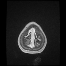 Cerebral and spinal tuberculosis (Radiopaedia 90489-107837 Axial T1 C+ 179).jpg