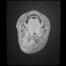 Cerebral and spinal tuberculosis (Radiopaedia 90489-107837 Axial T1 C+ 4).jpg