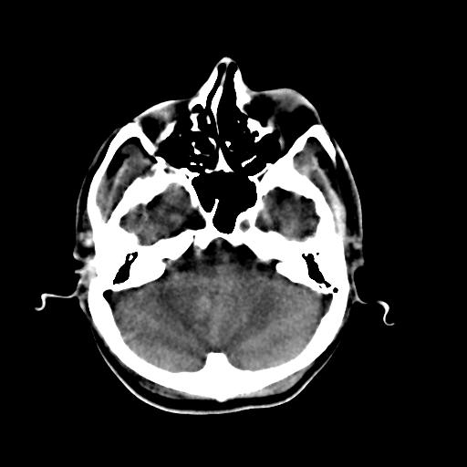 Cerebral arteriovenous malformation (Radiopaedia 28518-28759 Axial non-contrast 16).jpg