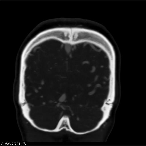 Cerebral arteriovenous malformation (Radiopaedia 28518-28759 C 70).jpg