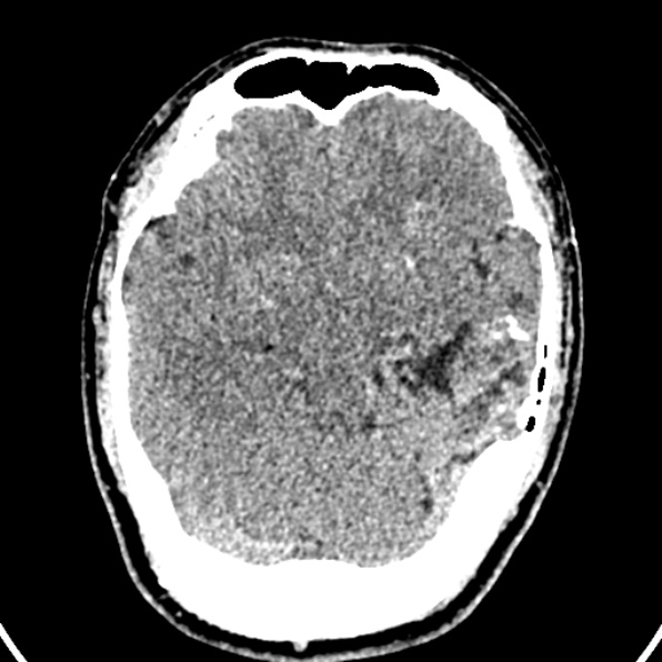 File:Cerebral arteriovenous malformation (Radiopaedia 37182-39012 Axial non-contrast 20).jpg