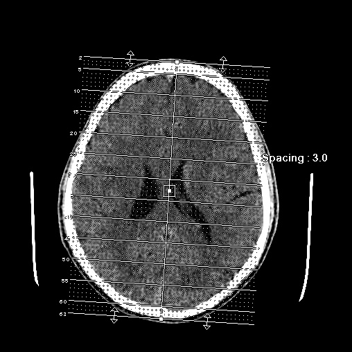 Cerebral arteriovenous malformation (Radiopaedia 61964-70028 Coronal non-contrast 1).jpg