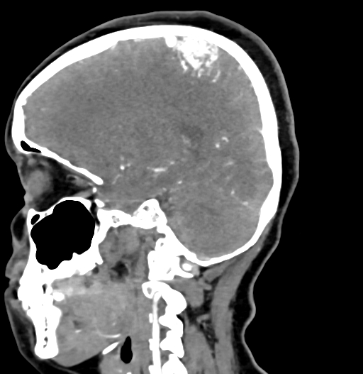 Cerebral arteriovenous malformation (Radiopaedia 73830-84645 D 59).jpg