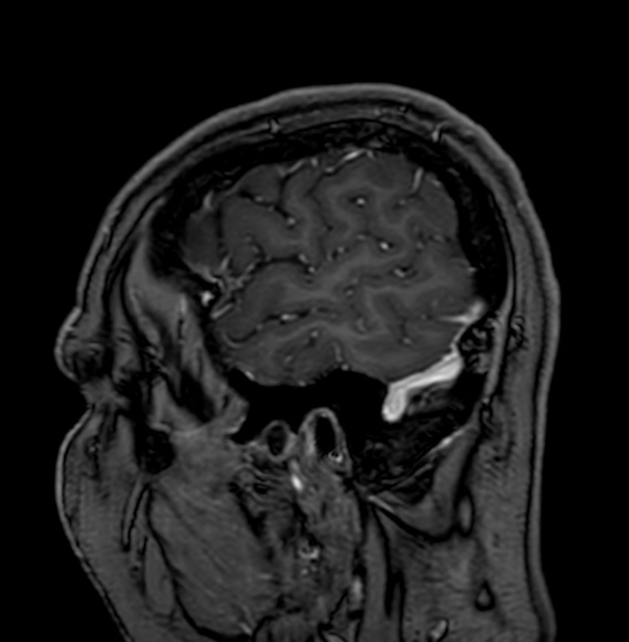 Cerebral arteriovenous malformation (Radiopaedia 74411-85746 Sagittal T1 C+ 11).jpg