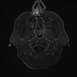 Cerebral arteriovenous malformation (Radiopaedia 84015-99245 Axial T1 C+ 3).jpg