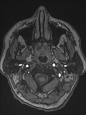 Cerebral arteriovenous malformation (Radiopaedia 84015-99245 Axial TOF 13).jpg