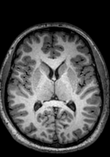 Cerebral arteriovenous malformation at posterior body of corpus callosum (Radiopaedia 74111-84925 Axial T1 137).jpg