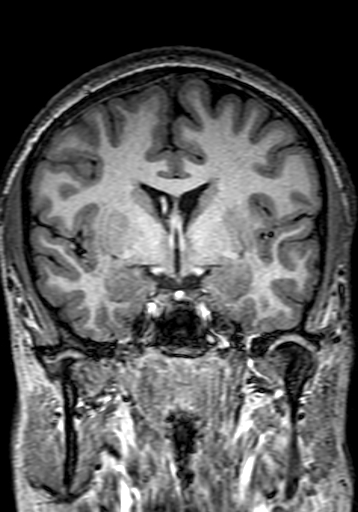 Cerebral arteriovenous malformation at posterior body of corpus callosum (Radiopaedia 74111-84925 Coronal T1 141).jpg