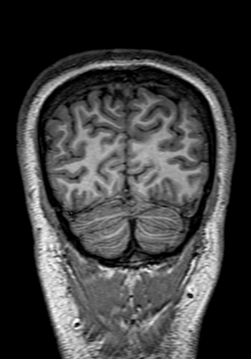 File:Cerebral arteriovenous malformation at posterior body of corpus callosum (Radiopaedia 74111-84925 Coronal T1 307).jpg