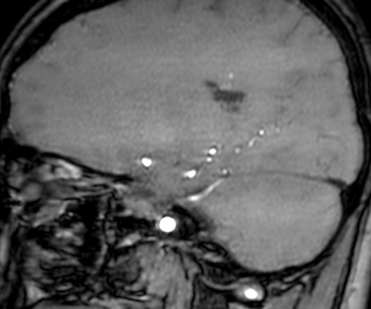 Cerebral arteriovenous malformation at posterior body of corpus callosum (Radiopaedia 74111-84925 J 140).jpg