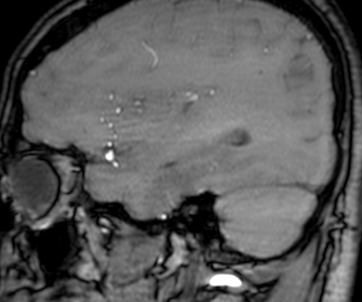 Cerebral arteriovenous malformation at posterior body of corpus callosum (Radiopaedia 74111-84925 J 90).jpg
