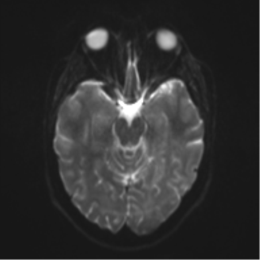 File:Cerebral cavernoma and development venous anomaly (Radiopaedia 37603-39482 Axial DWI 9).png