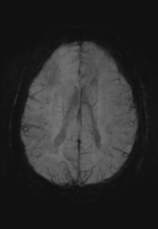 File:Cerebral cavernoma and development venous anomaly (Radiopaedia 37603-39482 Axial SWI MIP 23).png