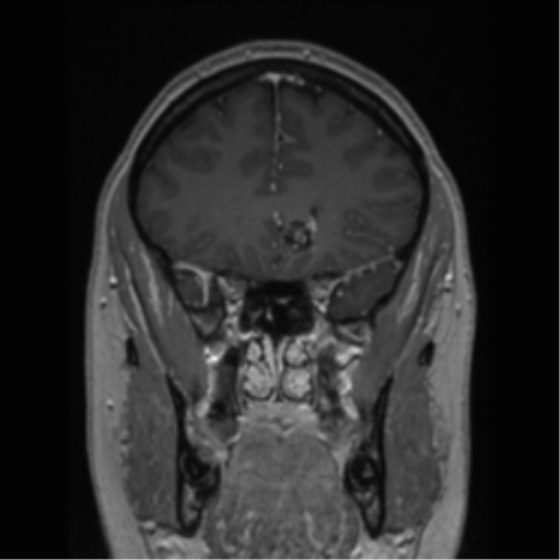 Cerebral cavernoma and development venous anomaly (Radiopaedia 37603-39482 Coronal T1 C+ 67).png