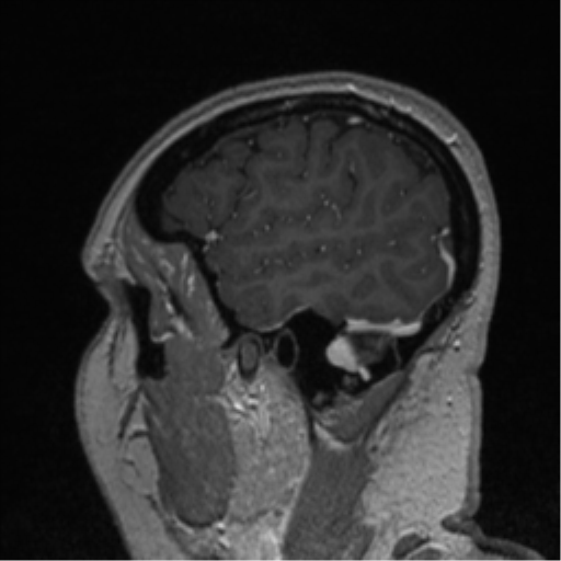File:Cerebral cavernoma and development venous anomaly (Radiopaedia 37603-39482 Sagittal T1 C+ 79).png