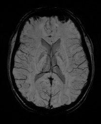 Cerebral cavernous venous malformation (Radiopaedia 70008-80021 Axial SWI 38).jpg