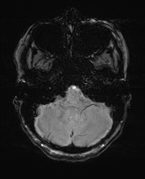 File:Cerebral cavernous venous malformation (Radiopaedia 70008-80021 I 13).jpg