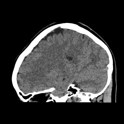 Cerebral cavernous venous malformation (Radiopaedia 70008-80022 C 21).jpg