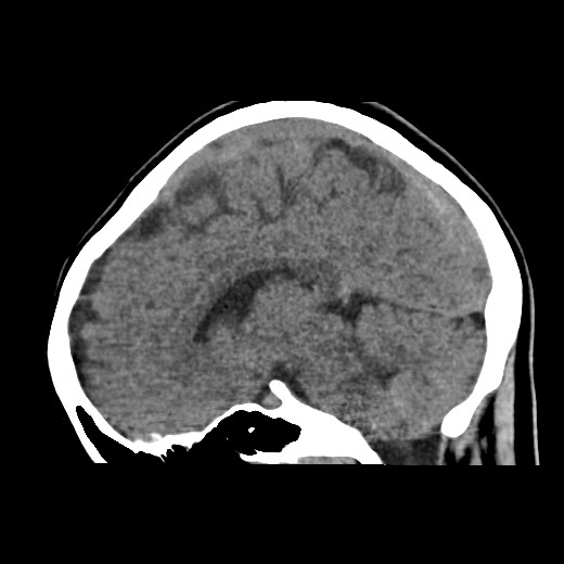 File:Cerebral cavernous venous malformation (Radiopaedia 70008-80022 C 27).jpg
