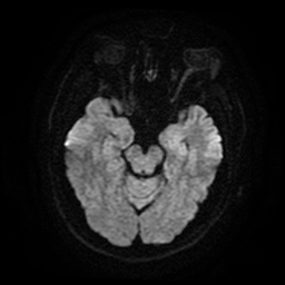 Cerebral cavernous venous malformation (Zabramski type II) (Radiopaedia 85511-101198 Axial DWI 46).jpg