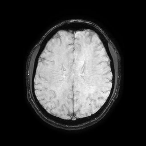 Cerebral cavernous venous malformation (Zabramski type II) (Radiopaedia 85511-101198 Axial SWI 81).jpg