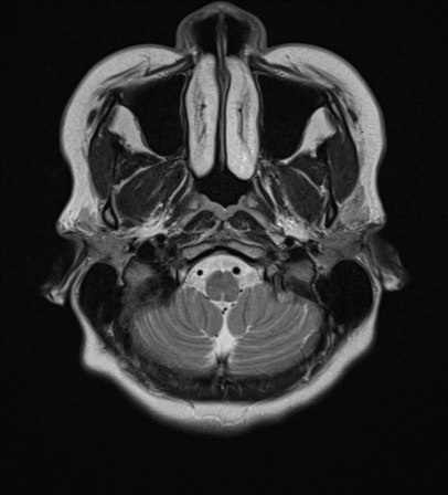 File:Cerebral cavernous venous malformations (Radiopaedia 48117-52946 Axial T2 2).png