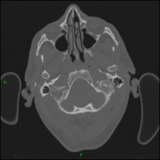 File:Cerebral contusions (Radiopaedia 33868-35039 Axial bone window 18).jpg