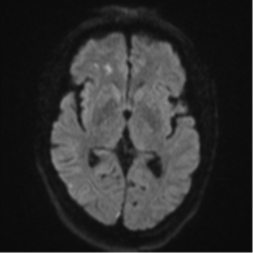 File:Cerebral embolic infarcts (embolic shower) (Radiopaedia 57395-64342 Axial DWI 54).png