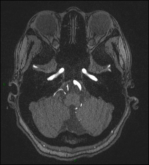 Cerebral fat embolism (Radiopaedia 35022-36525 Axial TOF 35).jpg