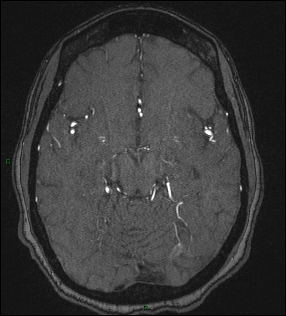 Cerebral fat embolism (Radiopaedia 35022-36525 Axial TOF 84).jpg