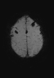 File:Cerebral hemorrhagic contusions- temporal evolution (Radiopaedia 40224-42757 Axial SWI 27).png